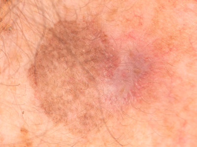 Large cell acanthoma
