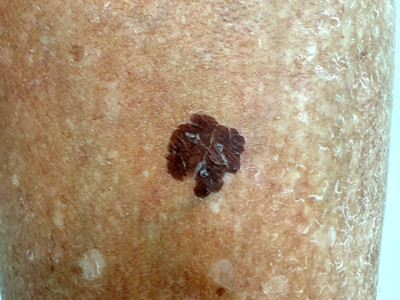 Large cell acanthoma