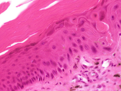 Large cell acanthoma