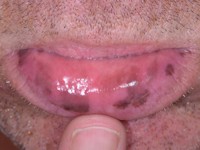 Laugier-Hunziker syndroom