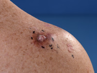 Cutaan leiomyosarcoma