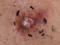 Cutaan leiomyosarcoma