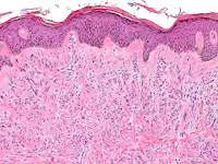 Cutaan leiomyosarcoma