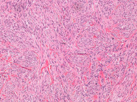 Cutaan leiomyosarcoma