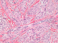 Cutaan leiomyosarcoma