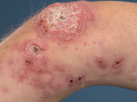 Diffuus cutane leishmaniasis