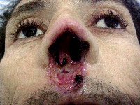 Mucocutane leishmanisasis