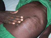 Viscerale Leishmanisasis