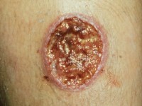 Cutane Leishmaniasis