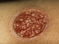 Cutane Leishmaniasis