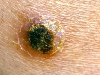 Cutane Leishmaniasis