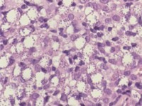 Cutane Leishmaniasis