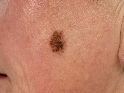 Lentigo maligna