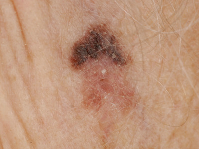 Lentigo maligna