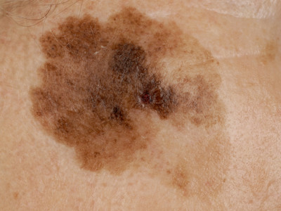 Lentigo maligna