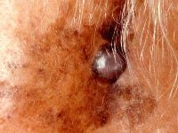 Melanoom in een lentigo maligna