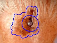 Melanoom in een lentigo maligna