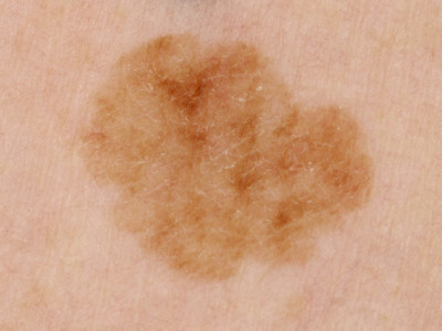 Lentigo senilis (solaris)