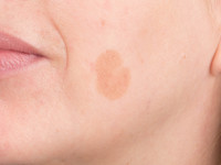 Lentigo senilis (solaris)