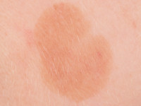 Lentigo senilis (solaris)