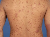 Borderline lepromateuze lepra