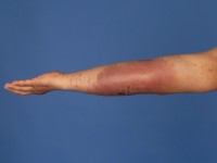 Borderline lepromateuze lepra