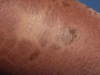 Borderline lepromateuze lepra