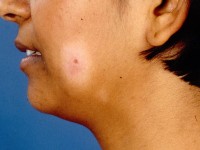 Borderline tuberculoide lepra