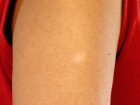 Borderline tuberculoide lepra