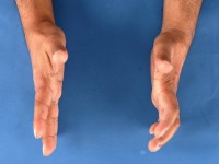 Borderline tuberculoide lepra