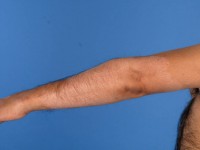 Borderline tuberculoid leprosy