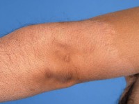 Borderline tuberculoide lepra