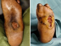 Lepra ulcera (neuropathie)