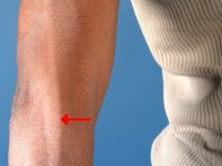 Leprosy, thickened nerves in reversal reaction