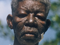Tuberculoid leprosy