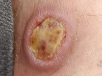 Leukemia cutis