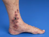 Leukocytoclastische vasculitis
