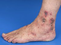 Leukocytoclastic vasculitis