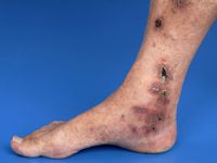 Leukocytoclastische vasculitis