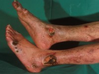 Leukocytoclastische vasculitis