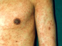 Leukocytoclastische vasculitis