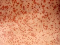 Leukocytoclastische vasculitis