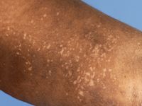 Leukoderma en confetti