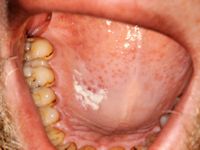 Leukoplakie
