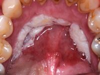 Leukoplakie
