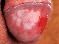 Leukoplakia penis