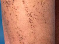Lichen amyloidosus