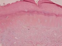 Lichen myxoedematosus