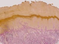 Lichen myxoedematosus