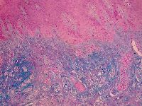 Lichen myxoedematosus